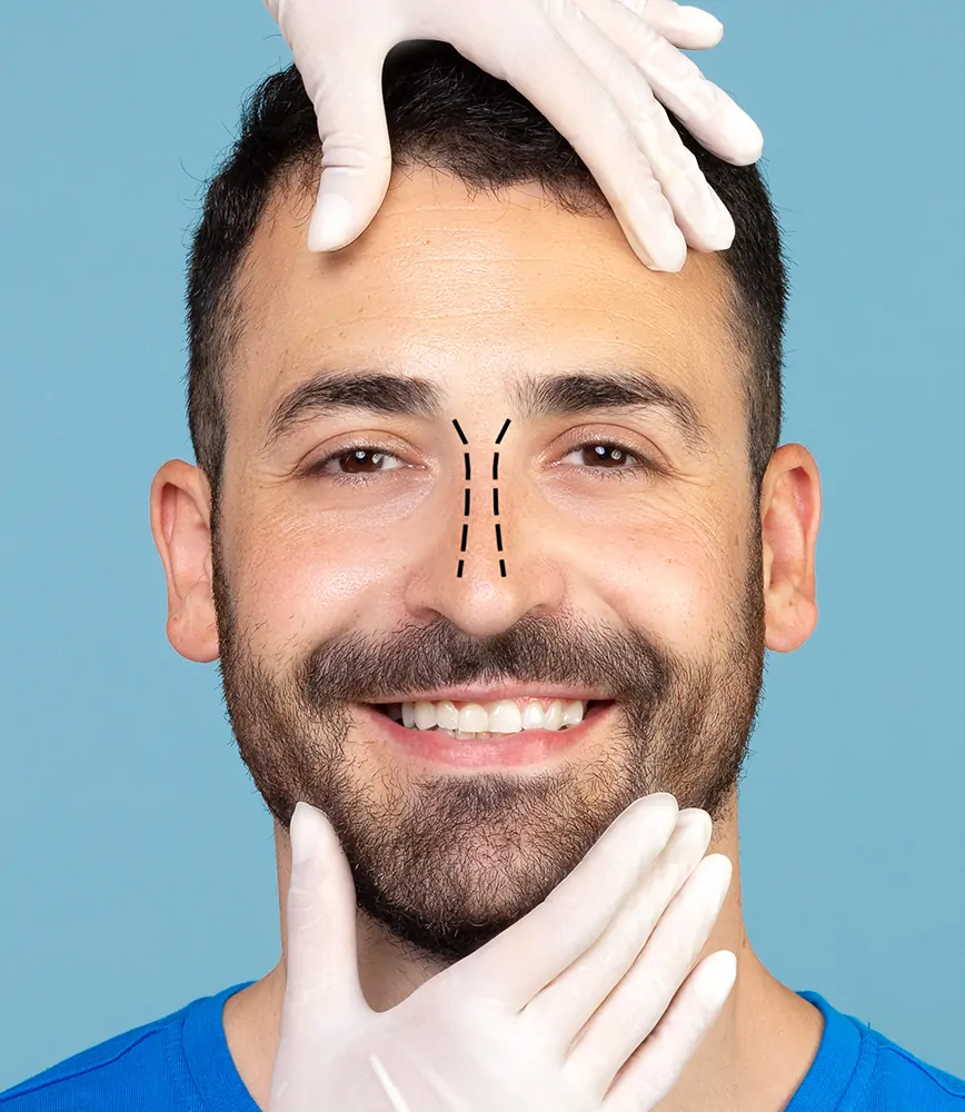 Revision Rhinoplasty