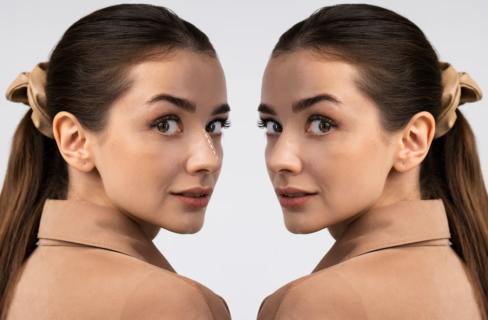 revision rhinoplasty, revision rhinoplasty surgery, revision nose esthetic
