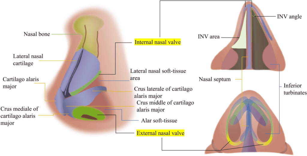 VISUAL EXPLANATION OPPORTUNITY: A clear, medically accurate cross section diagram of the nasal airway. The diagram explicitly labels the internal nasal valve, the septum, and the turbinates, demonstrating how external structural modifications can compress the internal airflow space.