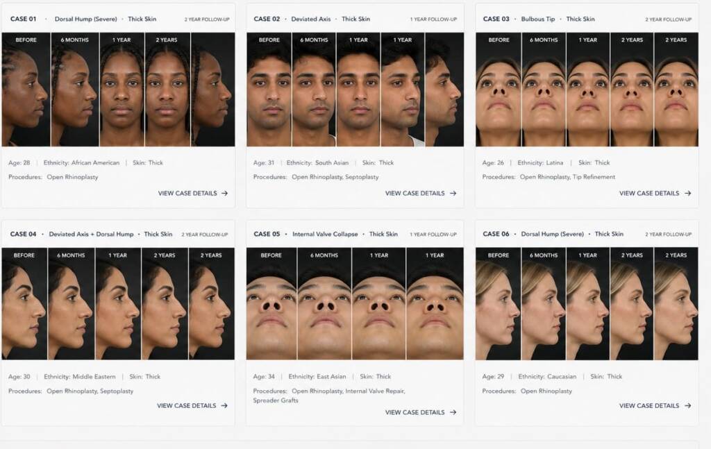 filtered case portfolio illustrating documented outcomes across diverse starting anatomies, including thick skin profiles, asymmetric bridges, and functional valve repairs.