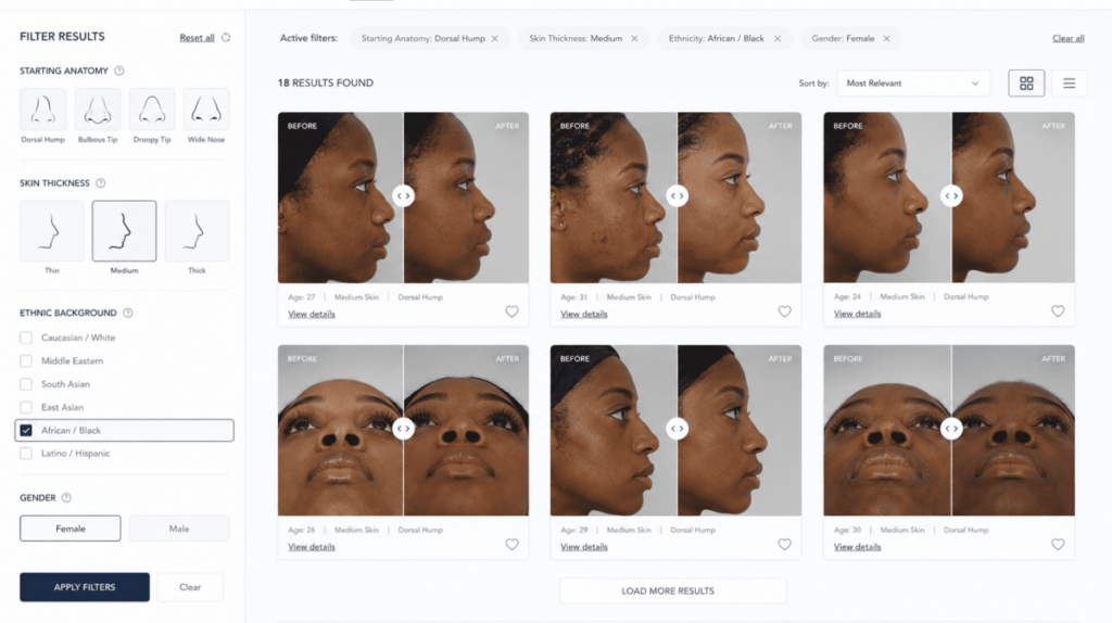 digital gallery interface demonstrating how patients can filter before and after results based on starting anatomy, skin thickness, and specific ethnic backgrounds, allowing them to find visual outcomes relevant to their own unique features.